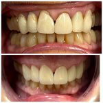 Smile Makeover Before and After