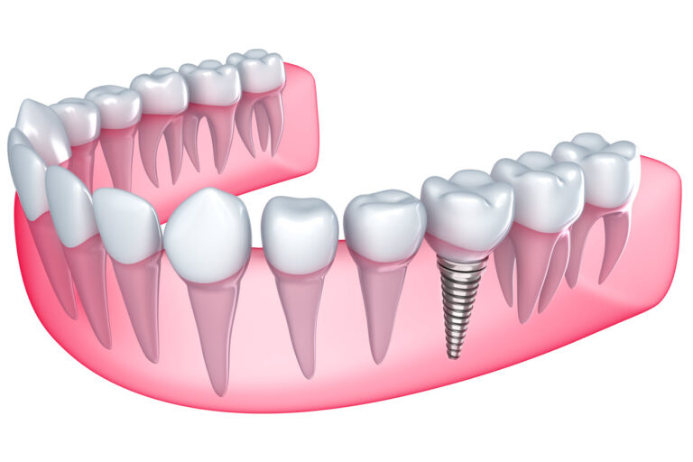 Dental Implants: What They Are & What to Expect | Downingtown Family Dentistry
