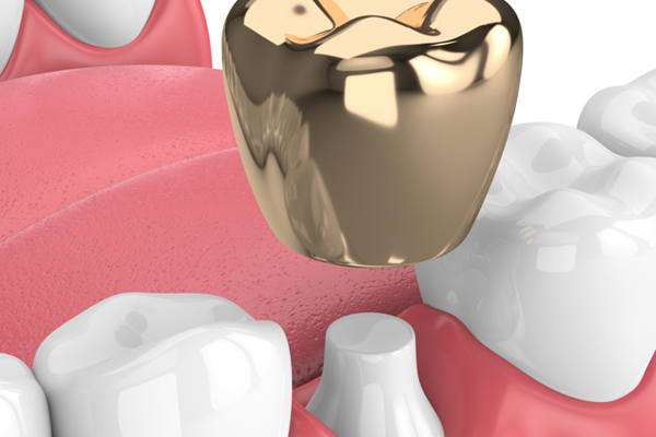 Are gold dental crowns right for you?