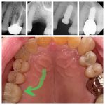 Implant Before and After