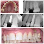 Implant Before and After