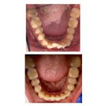 Invisalign Treatment