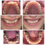 Invisalign Treatment