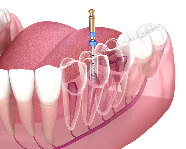 Root canal treatment downingtown family dentistry