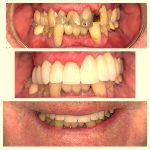 Smile Makeover Before and After