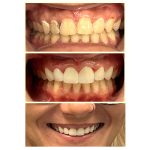 Smile Makeover Before and After