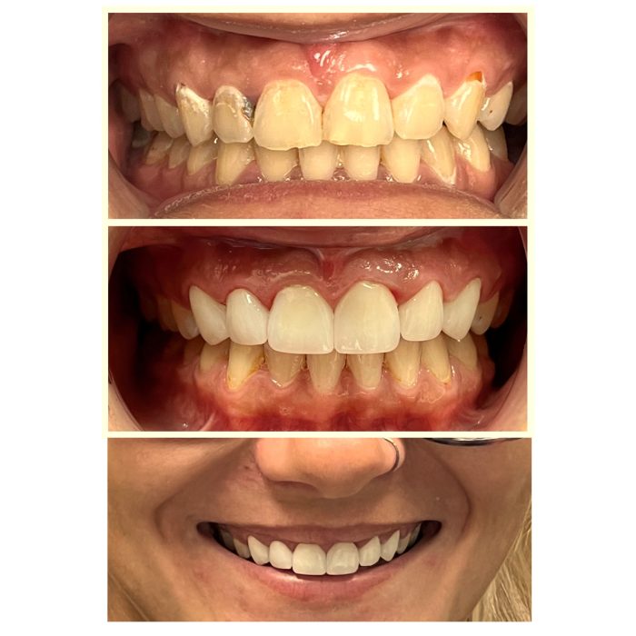 Smile Makeover Before and After
