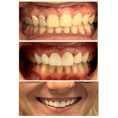 Smile Makeover Before and After