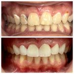 Smile Makeover Gallery