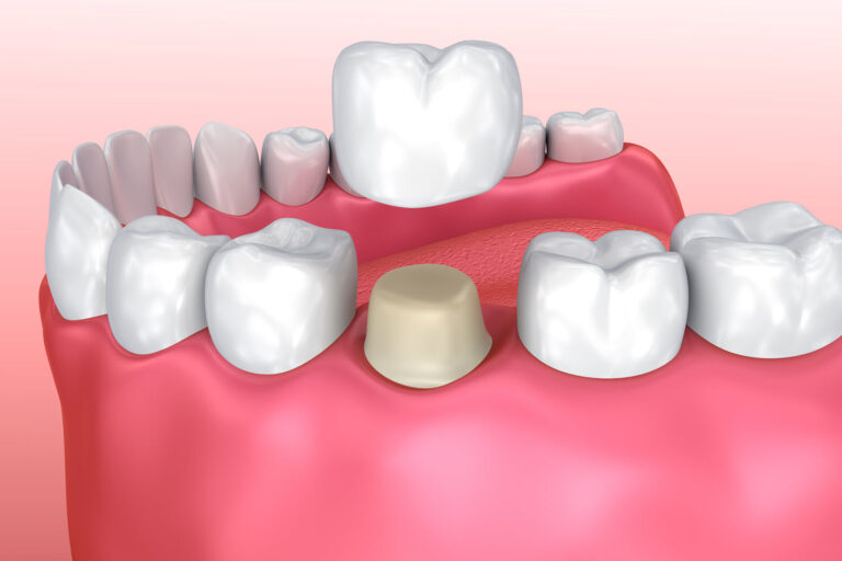 Weighing the Pros and Cons of Dental Crowns | Downingtown Family Dentistry