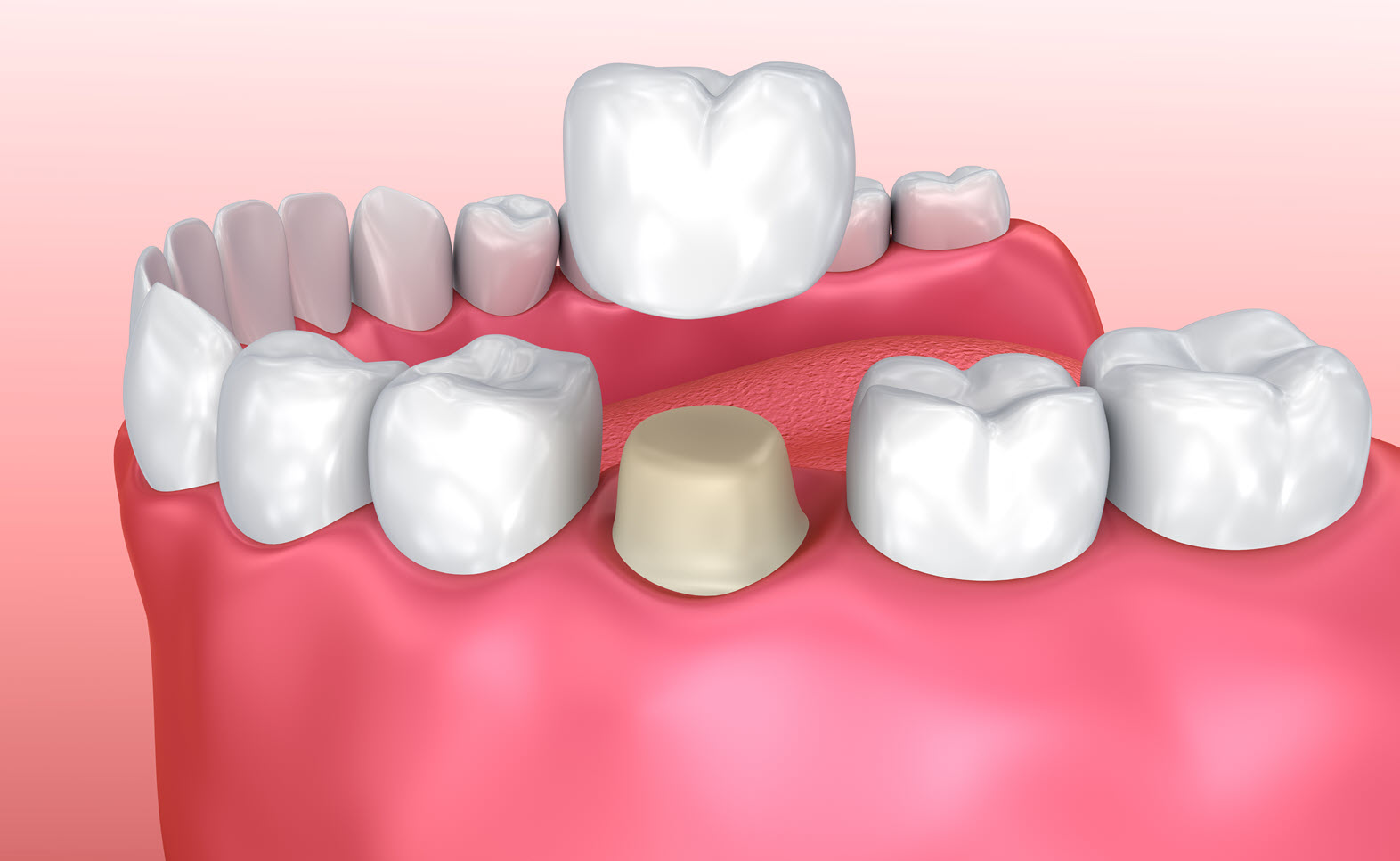 Weighing the Pros and Cons of Dental Crowns | Downingtown Family Dentistry