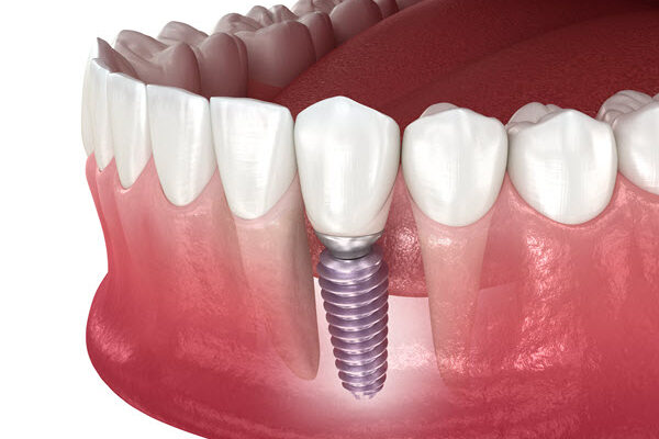 dental implants from Downingtown family dentistry