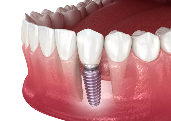 dental implants from Downingtown family dentistry