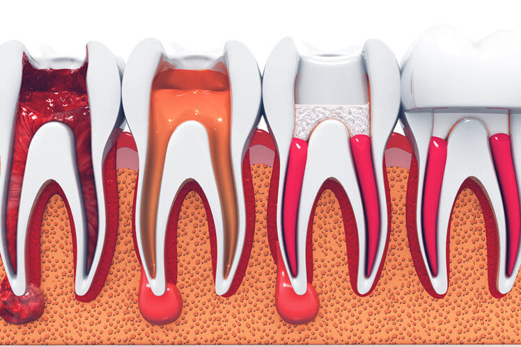 Root Canals: The Unfiltered Truth | Downingtown Family Dentistry