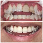 veneers before and after